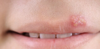 Opryszczka u dzieci